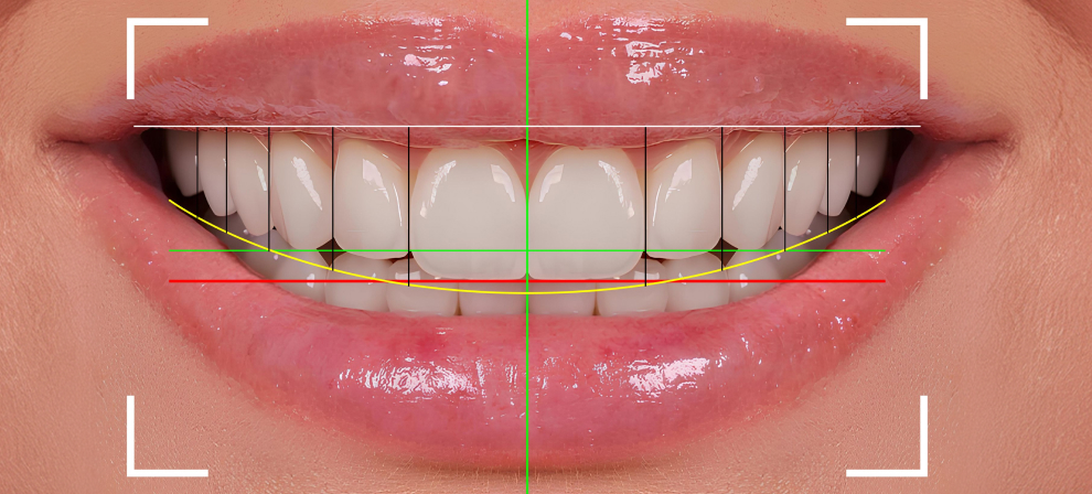 Digital Smile Design