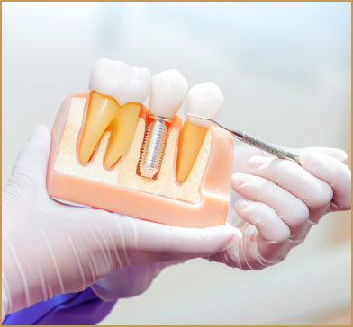 Neuilly sur Seine implant
